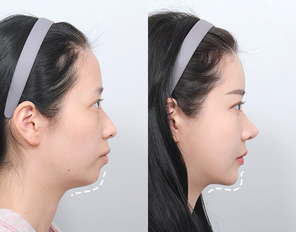 ✨ ทำคางที่เกาหลี พร้อมที่พัก ดูแลครบทุกขั้นตอน