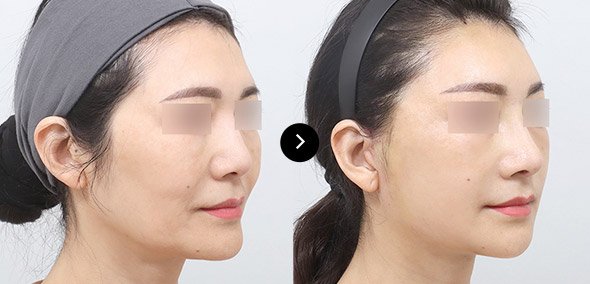 ทำคางที่เกาหลีพร้อมที่พัก